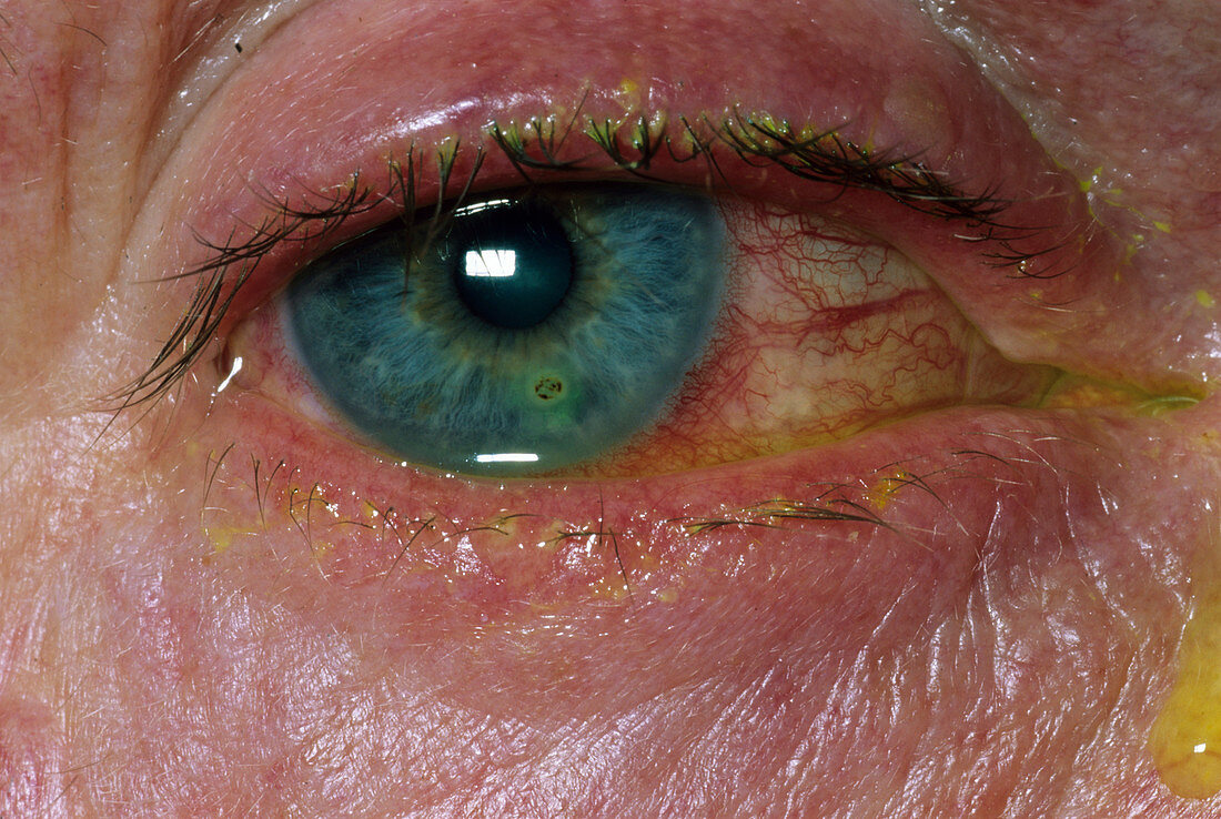 Removal of foreign body in eye