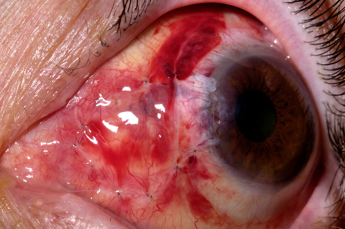 Eye after pterygium excision