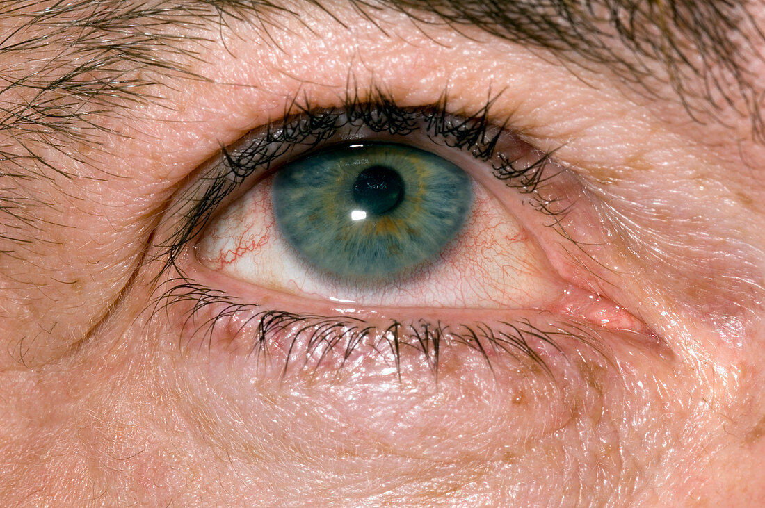 Inflamed iris