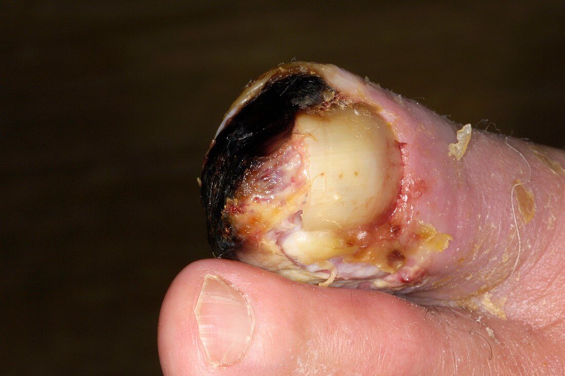 Gangrenous toe caused by diabetes