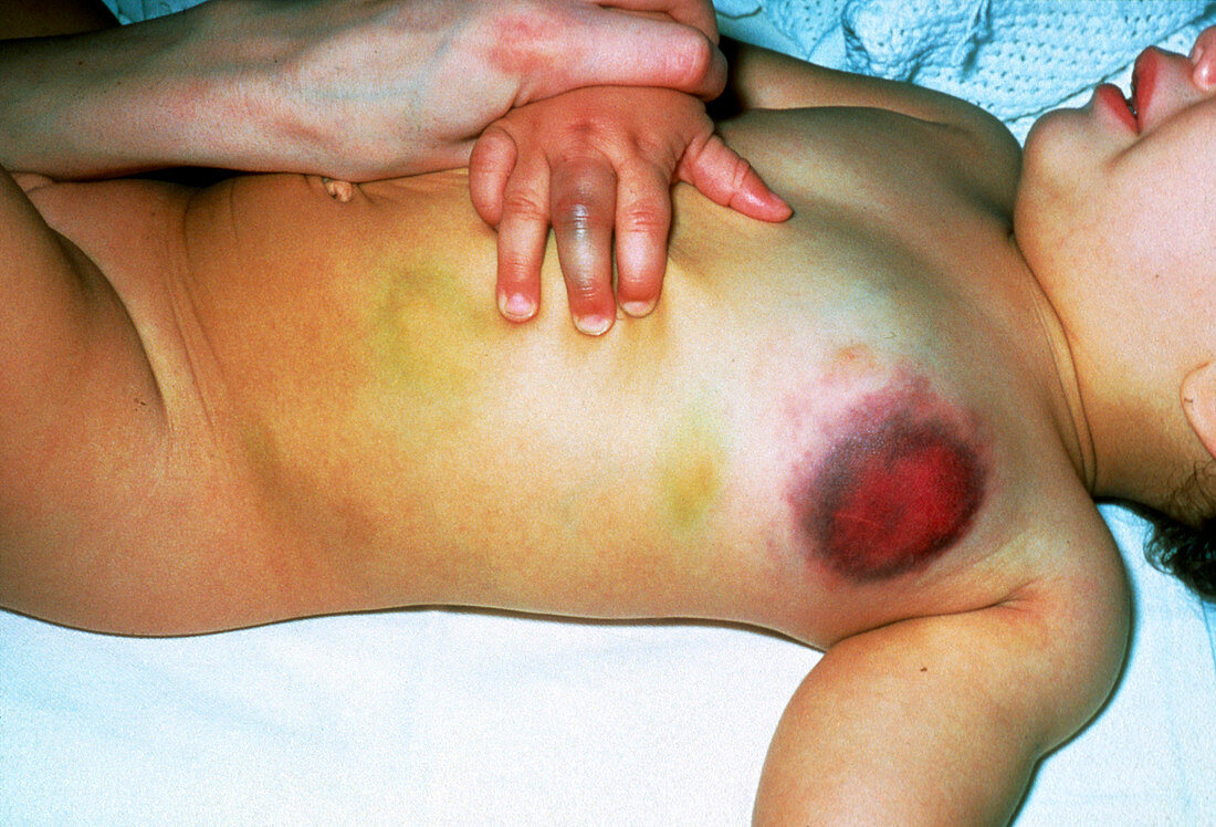 Baby suffering from haemophilia