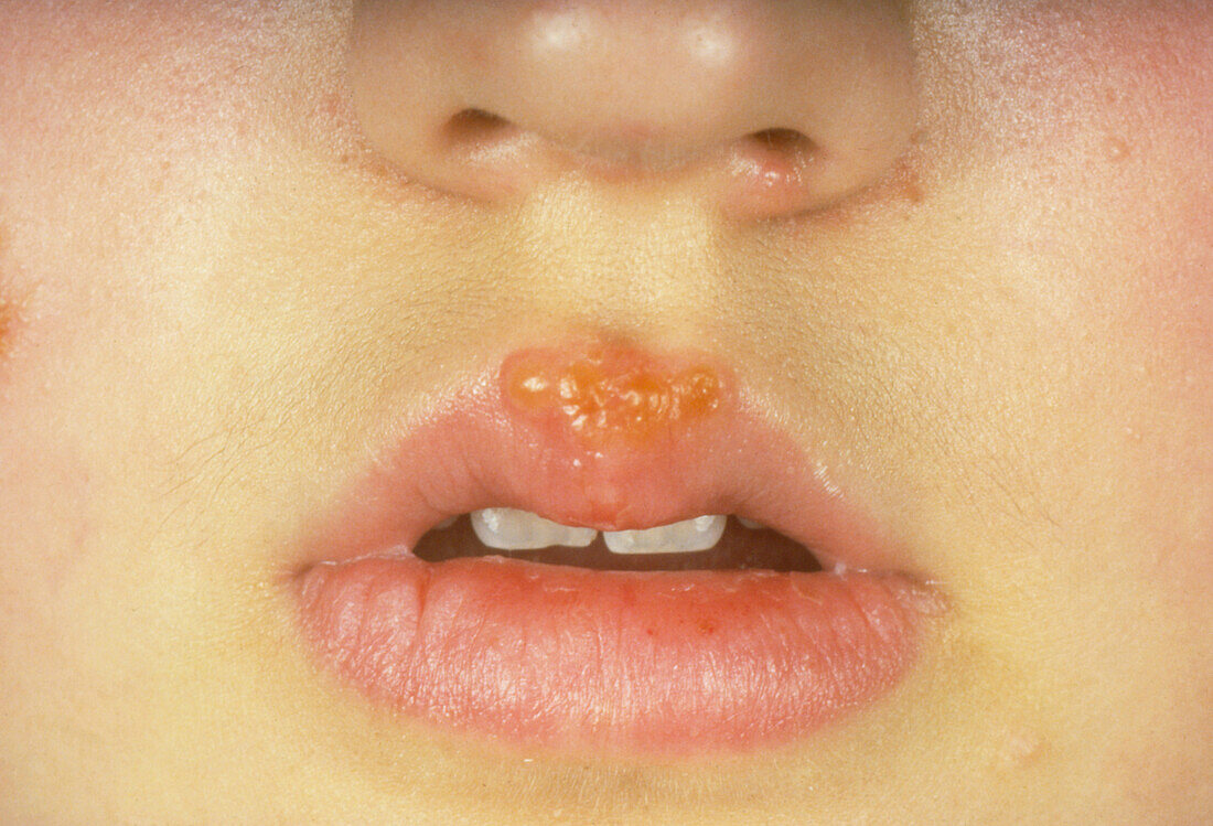 Girl with cold sore