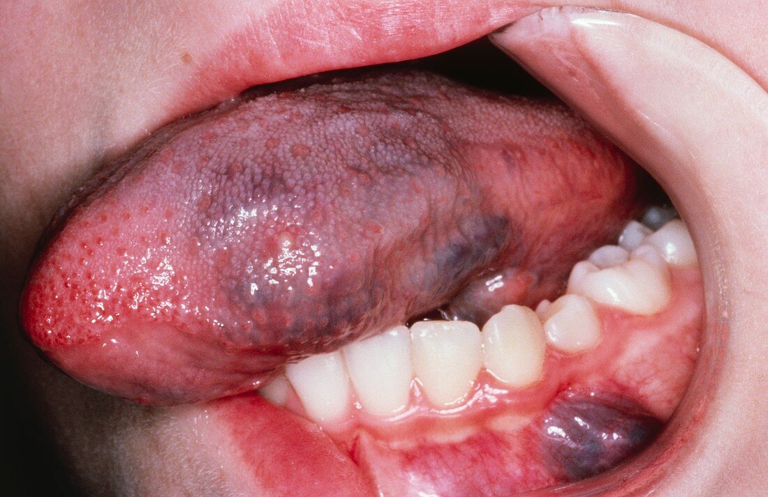 Haemangioma affecting the tongue