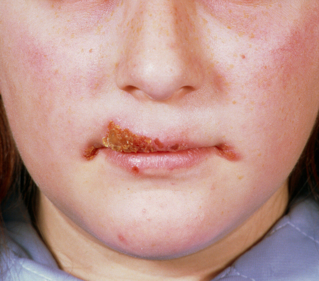 Herpes simplex sores on lip & mouth