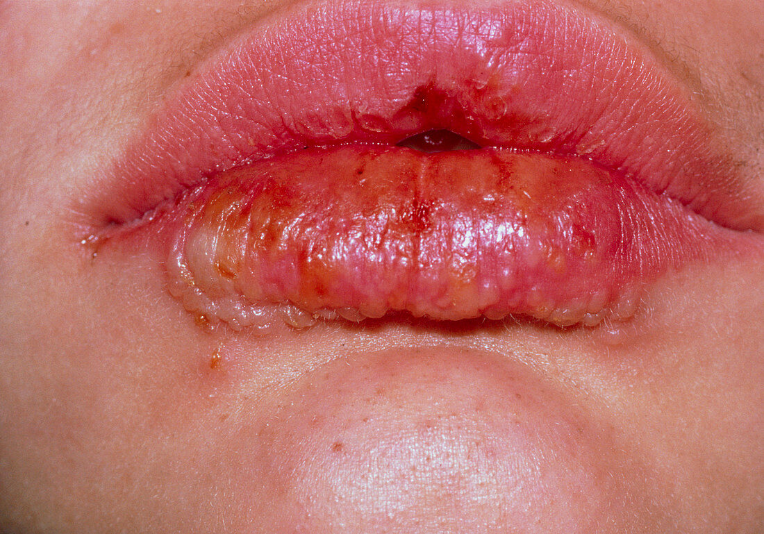 Lips infected by the Herpes simplex virus
