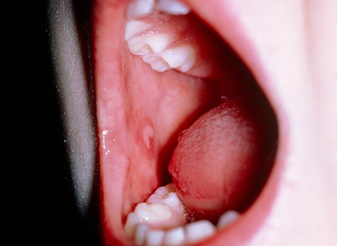 Hand,foot & mouth disease: mouth ulcer in child