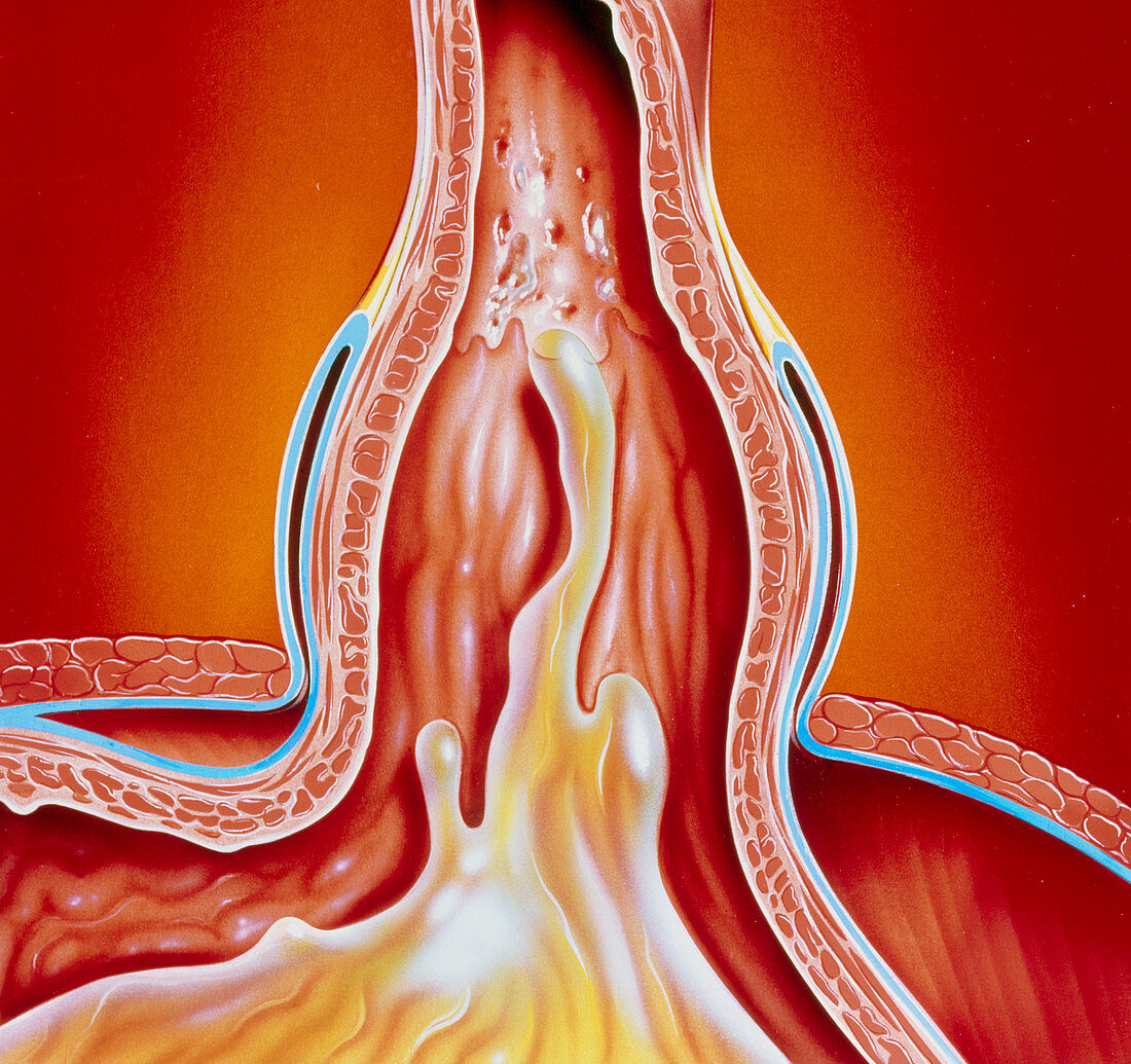 Art of gastro-oesophageal reflux in hiatus hernia
