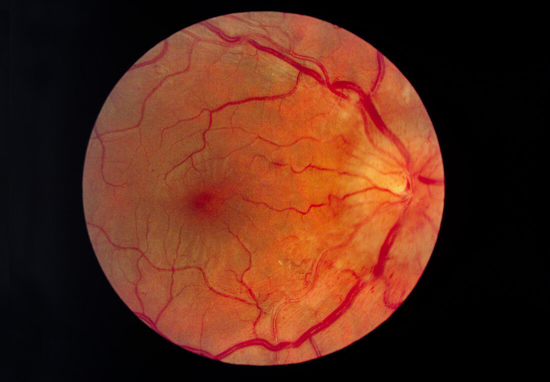 Ophthalmoscopy of the retina in hypertension
