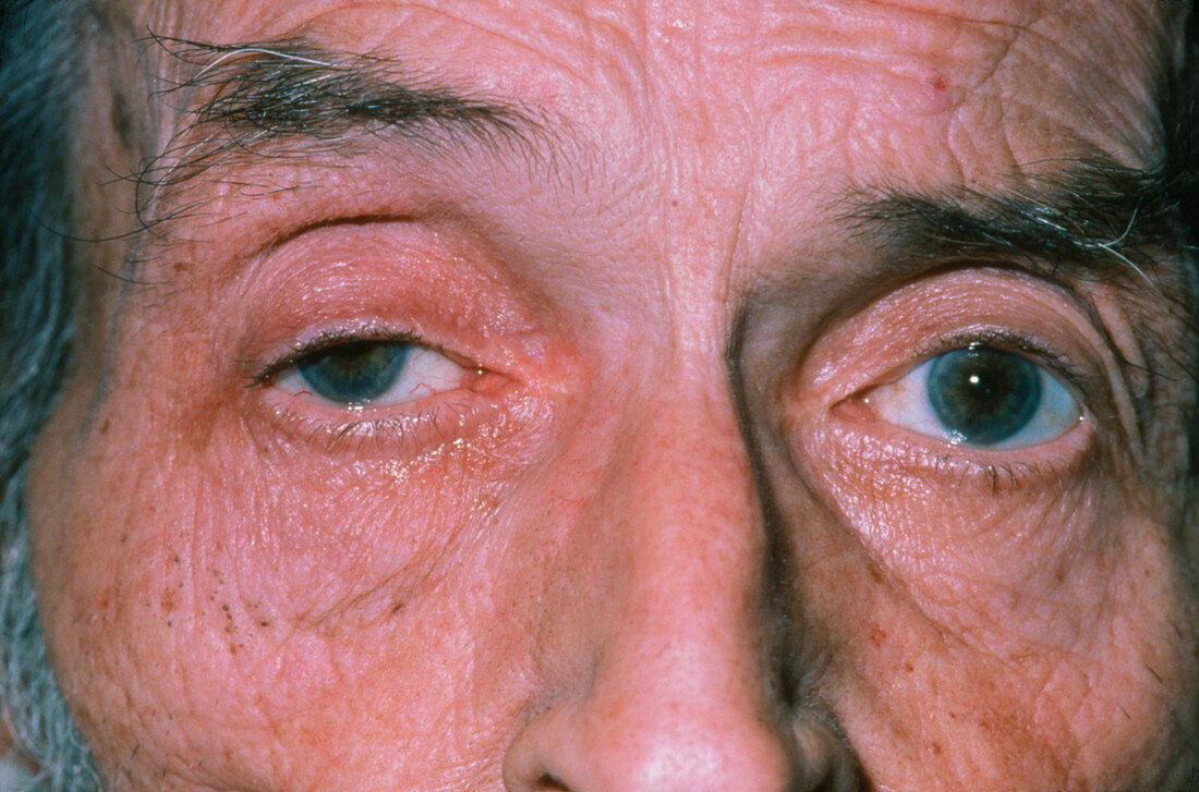 Man's face with Horner's syndrome