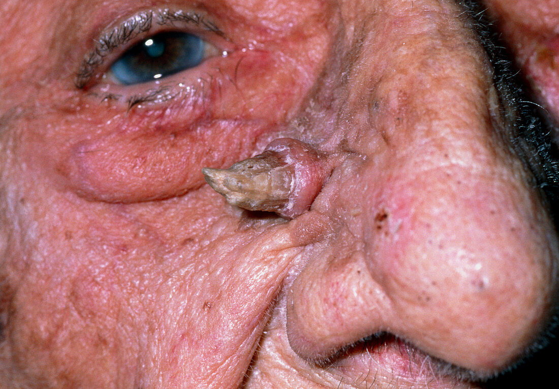 Cutaneous horn on face of 90 year-old woman