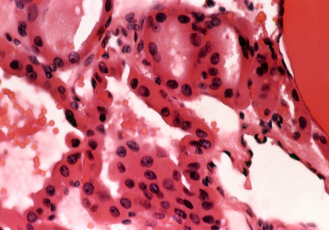 LM cross-section of a Hurthle cell thyroid tumour