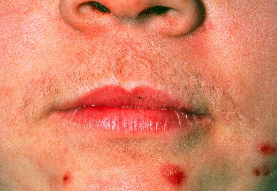 Hirsutism (excessive hairiness) on a woman's face