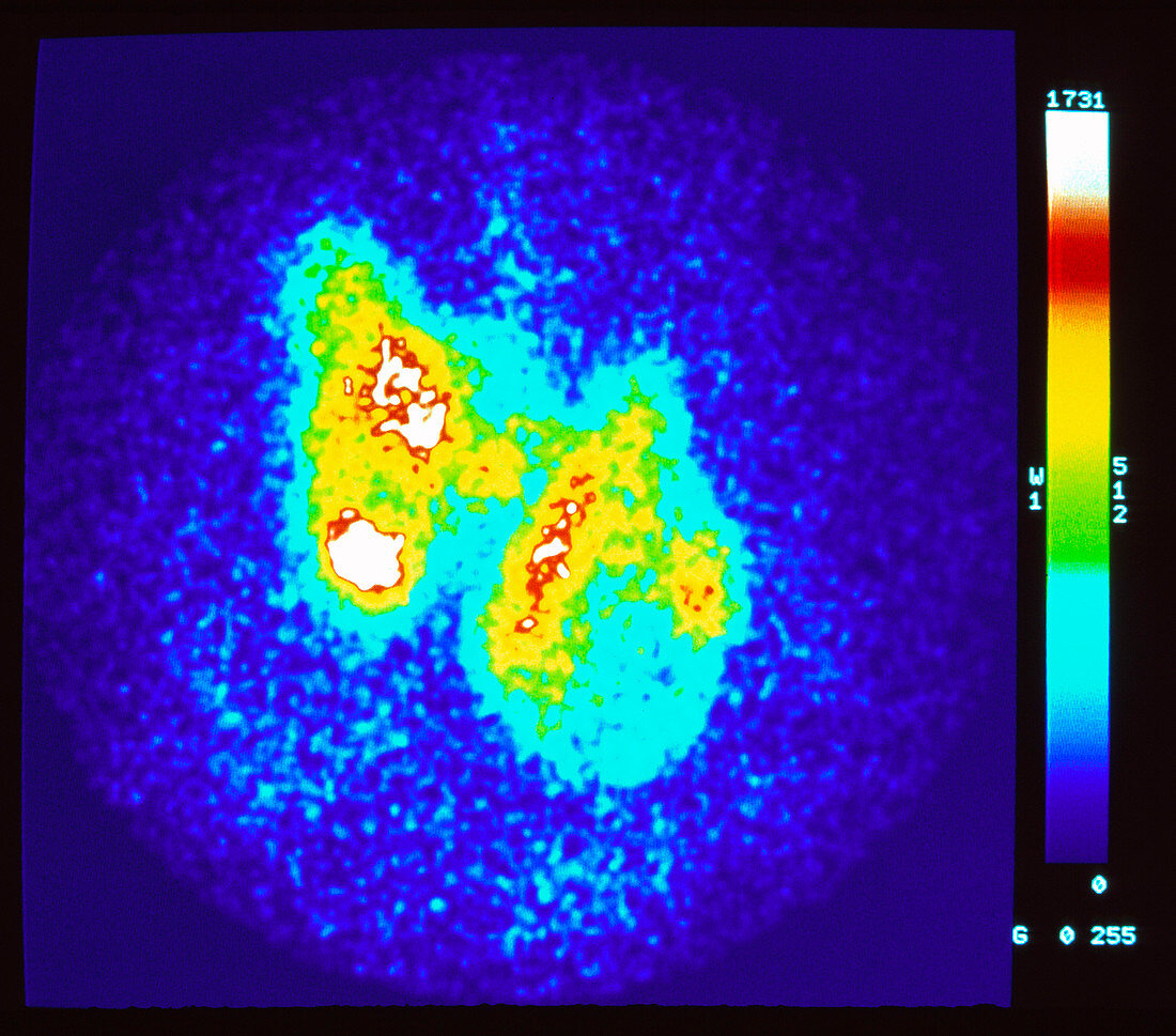 Coloured gamma scan of thyrotoxic hyperplasia
