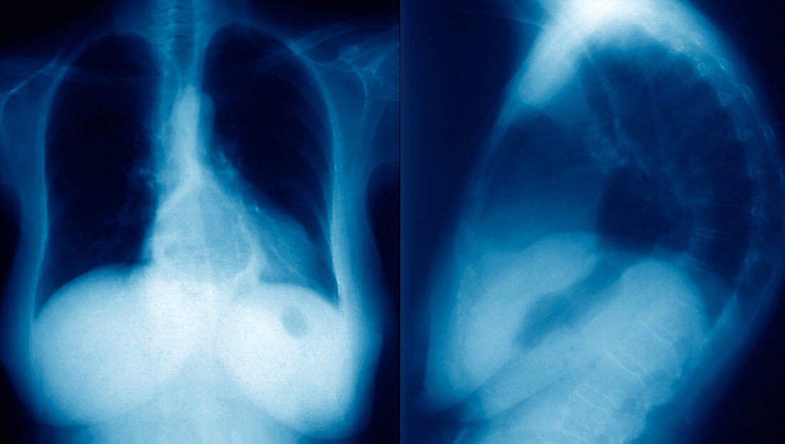 Hiatus hernia,X-rays