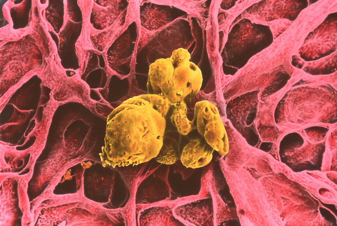 Coloured SEM of a gallstone in the gall bladder