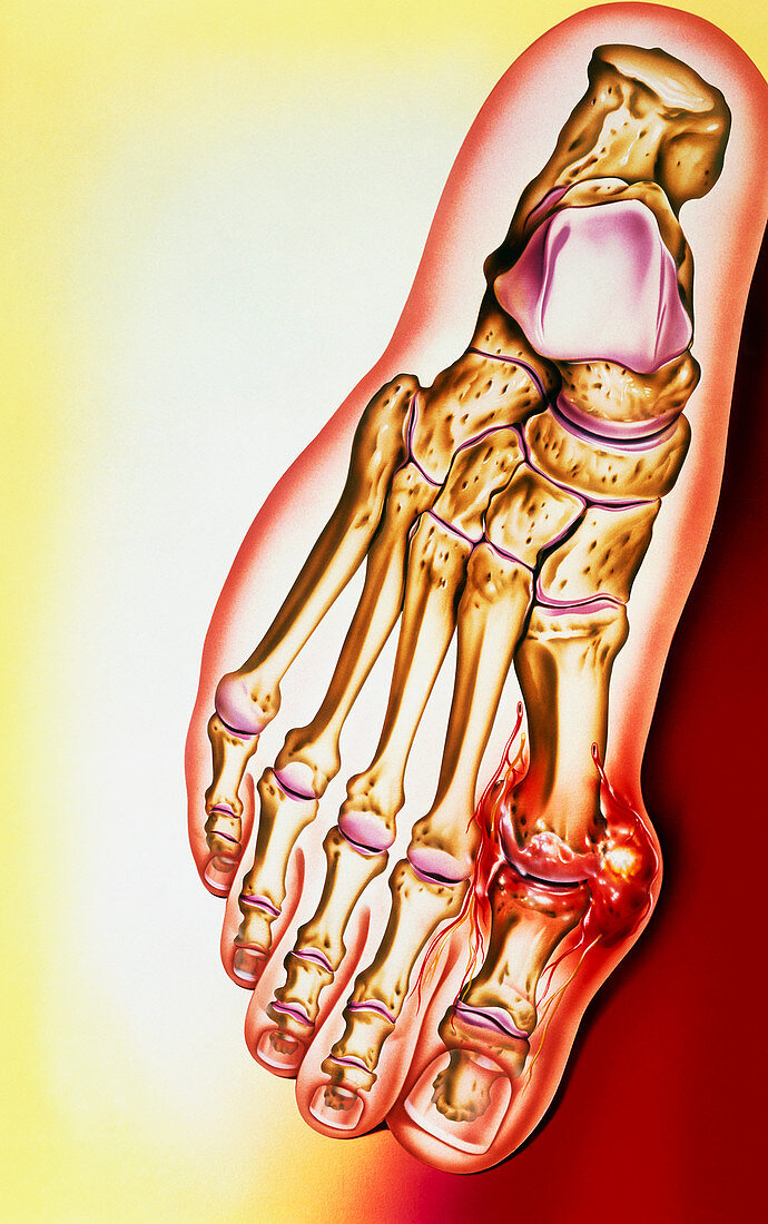 Artwork of gout: tophus at base of the big toe
