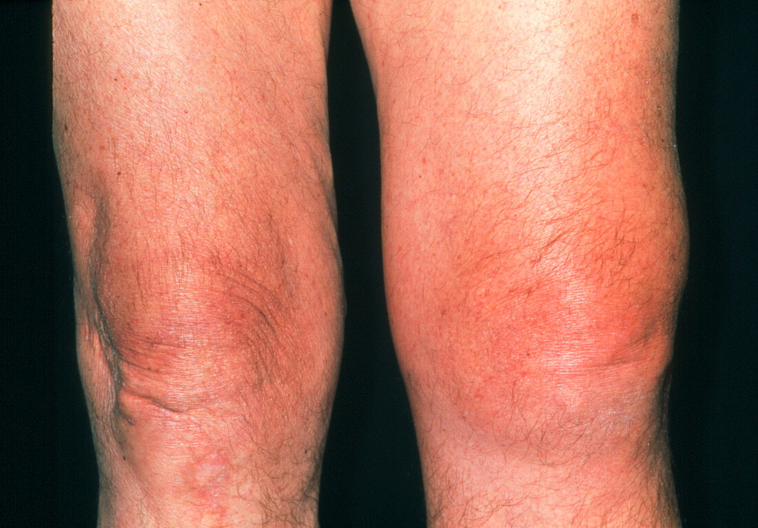 Inflamed knee of an elderly man affected by gout