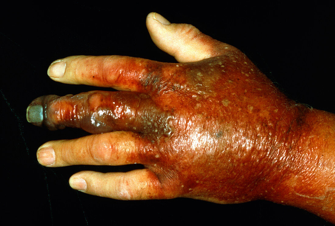 View of gangrene of a severely infected hand
