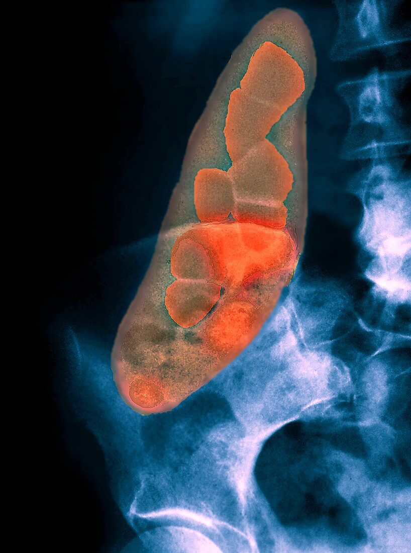 Porcelain gallbladder,X-ray