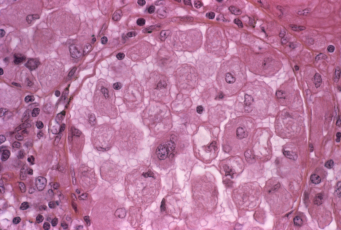 Gaucher's disease,light micrograph