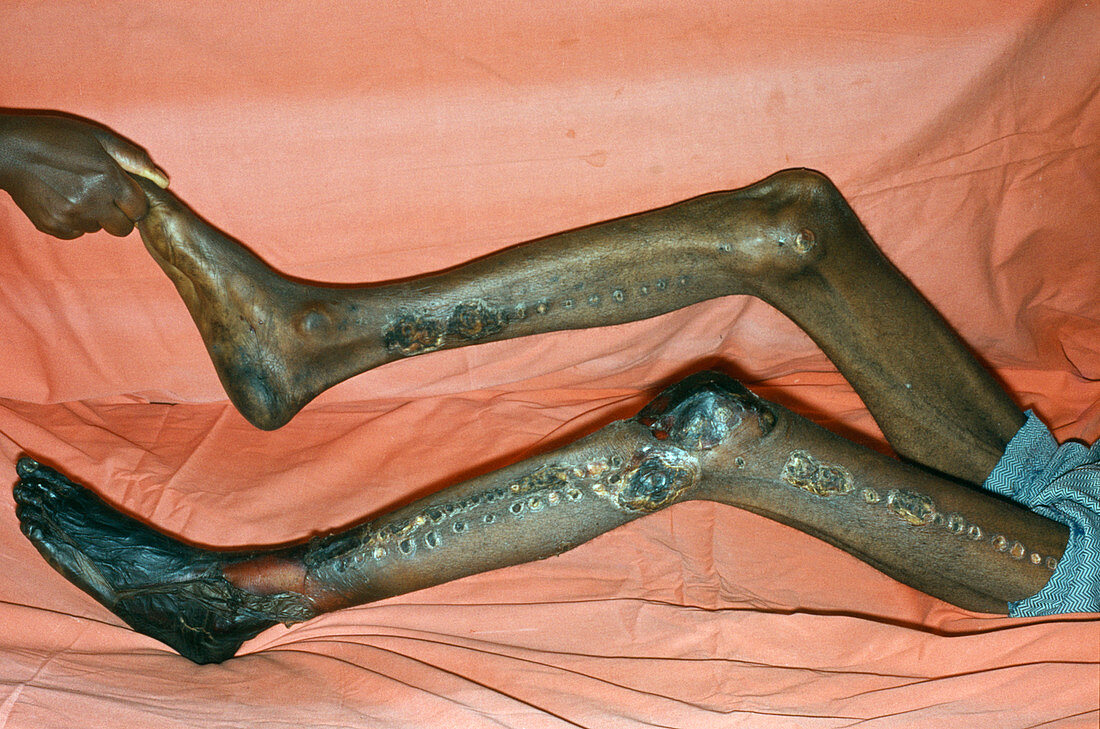 Gangrene of the legs