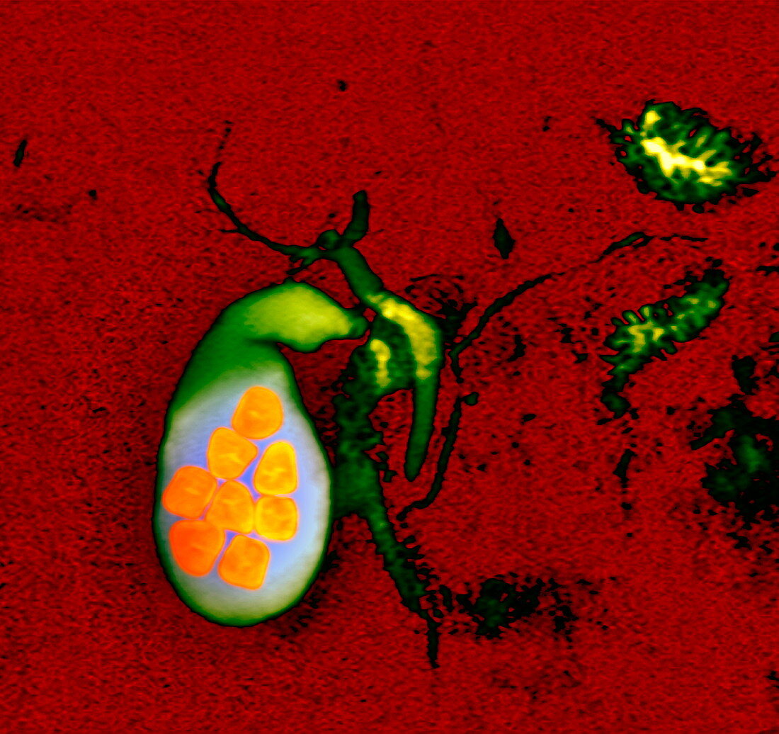 Gallstones