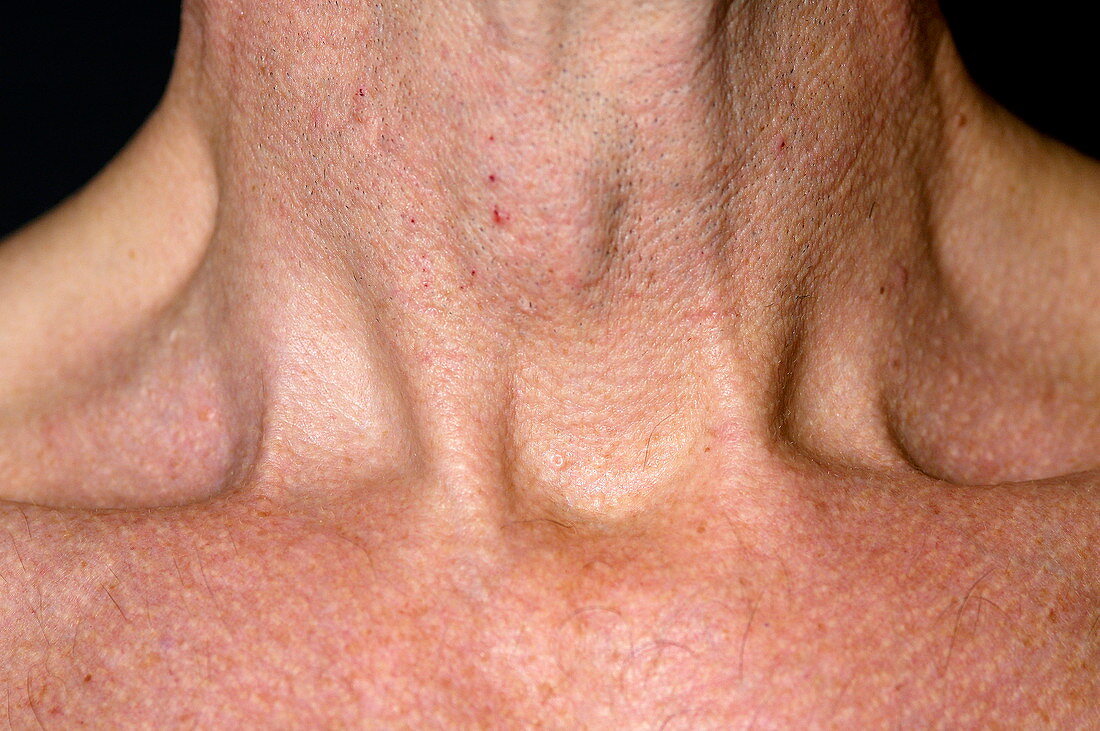 Swollen thyroid gland
