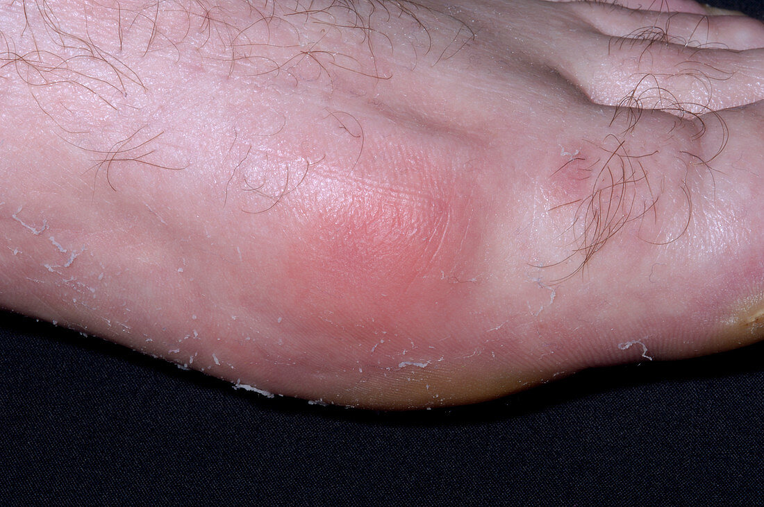 Gout of the big toe joint