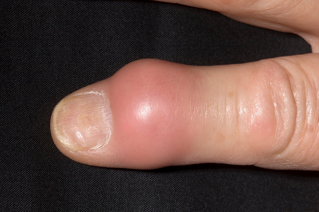 Gout in finger