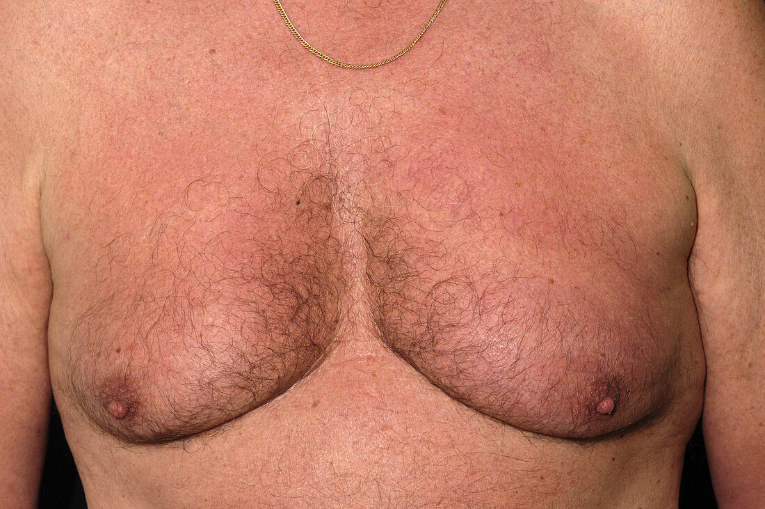 Gynaecomastia,male breasts