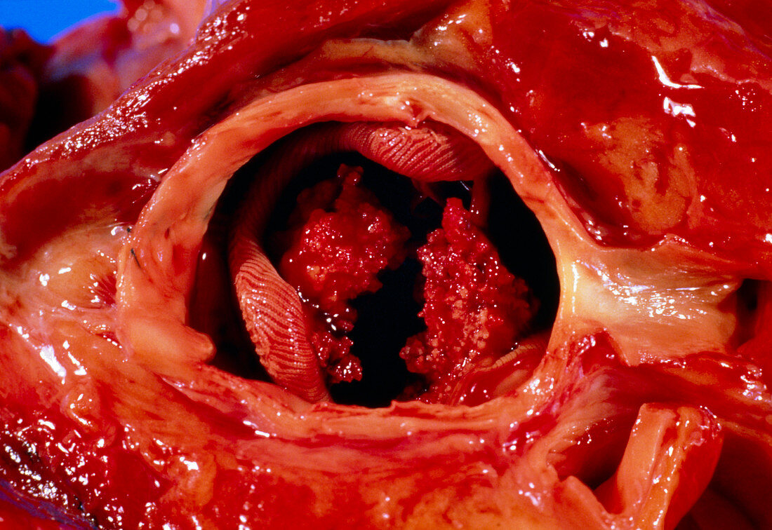 Artificial heart valve showing bacterial infection
