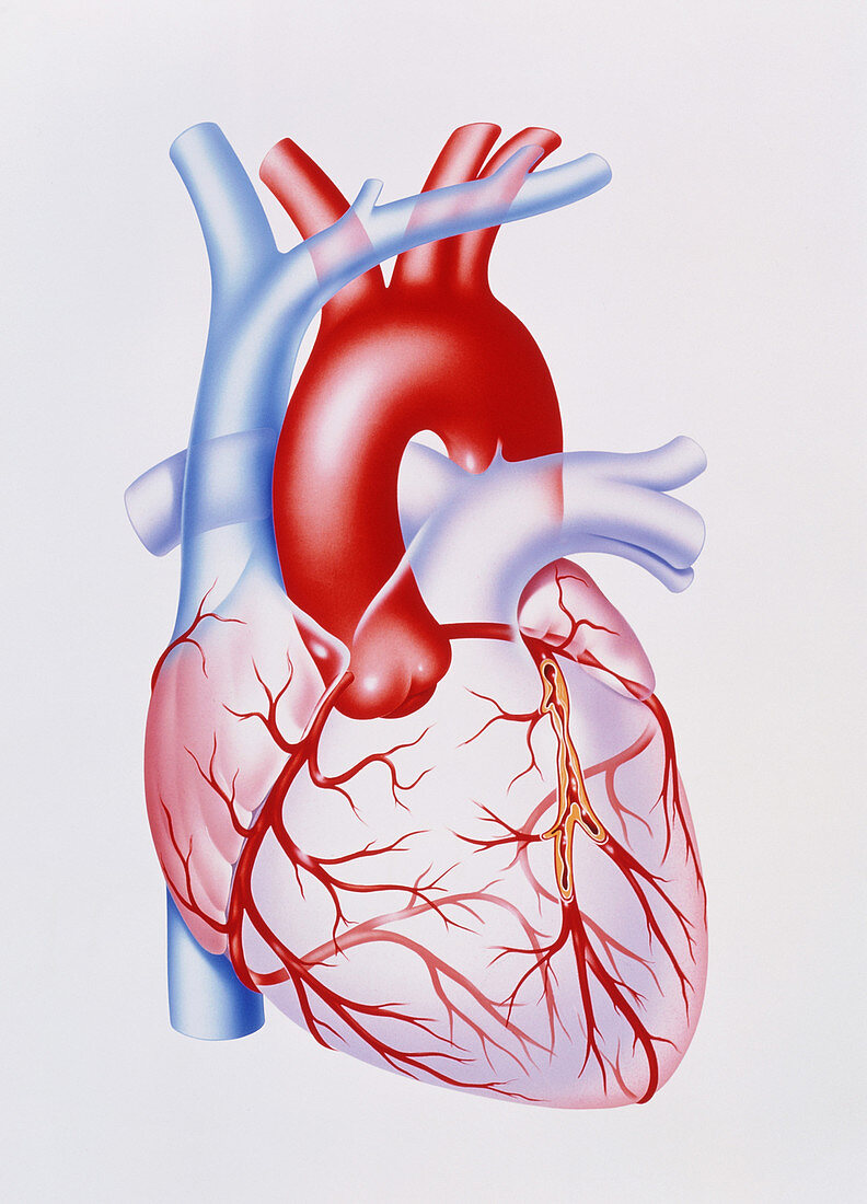 Artwork showing atherosclerosis of coronary artery