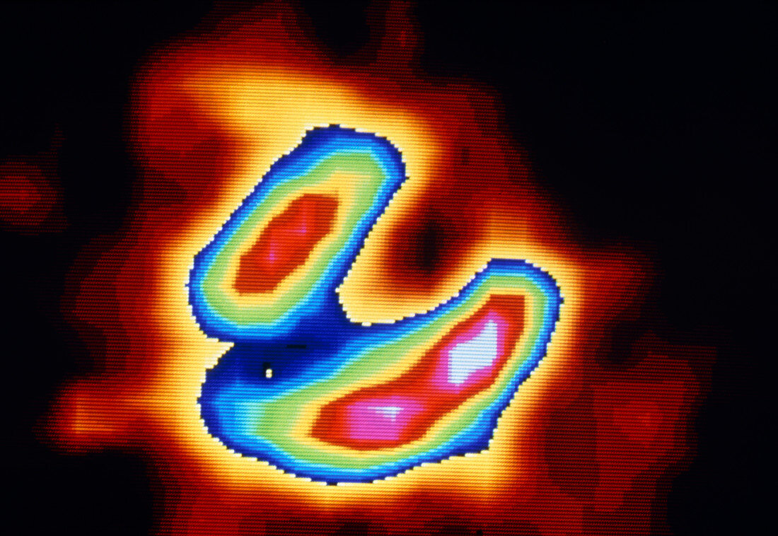 Coloured Gamma Scan of heart after heart attack