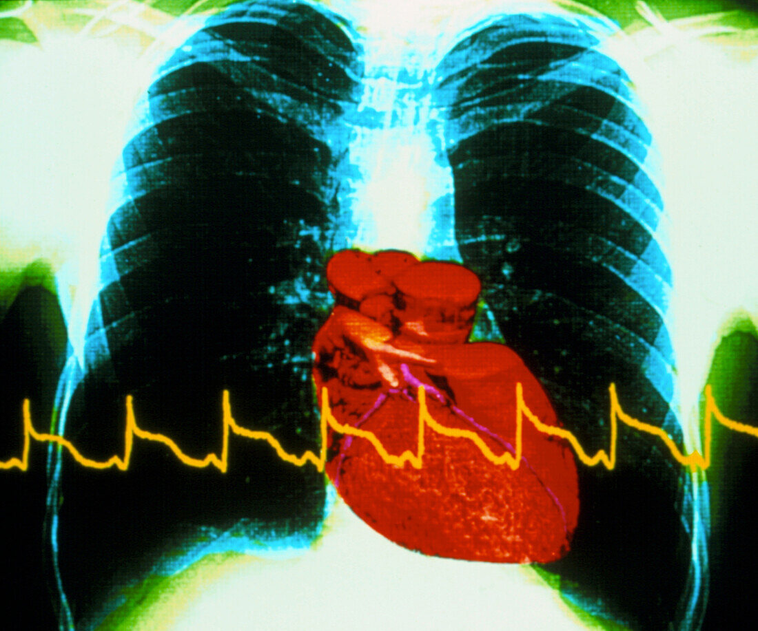 Colour chest X-ray with ECG trace in heart attack