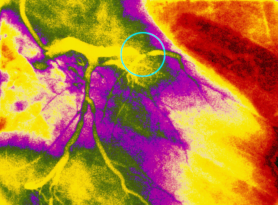 Colour angiogram of left coronary artery stenosis