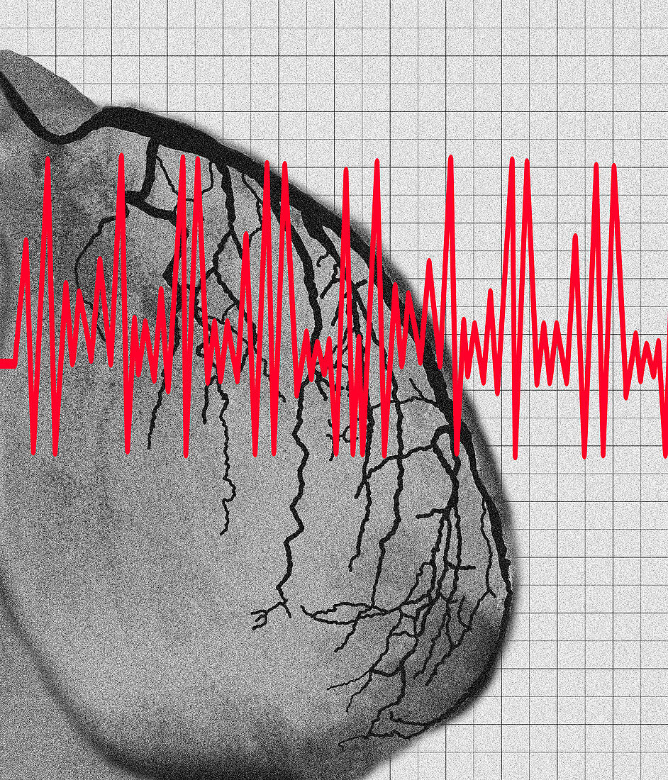 Heart attack: artwork of heart angiogram and ECG