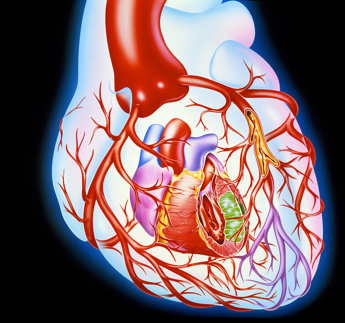 Artwork showing a heart with angina
