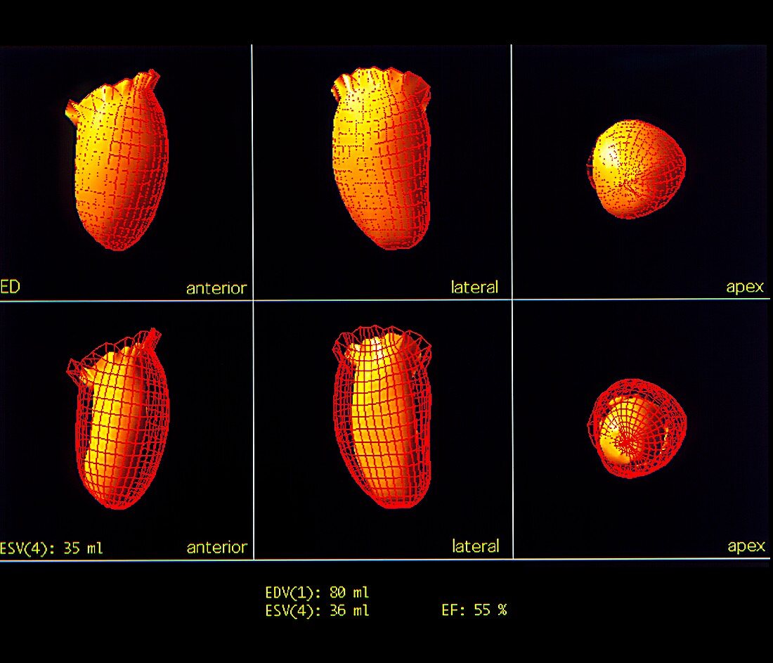 Heart after heart attack,3D models