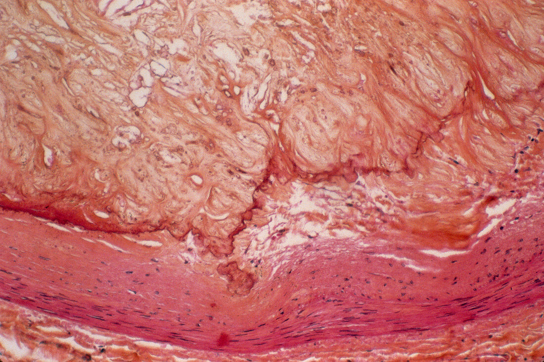 Atheroma plaque,light micrograph