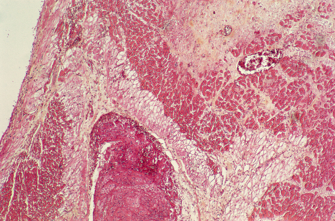 Heart tissue death,light micrograph