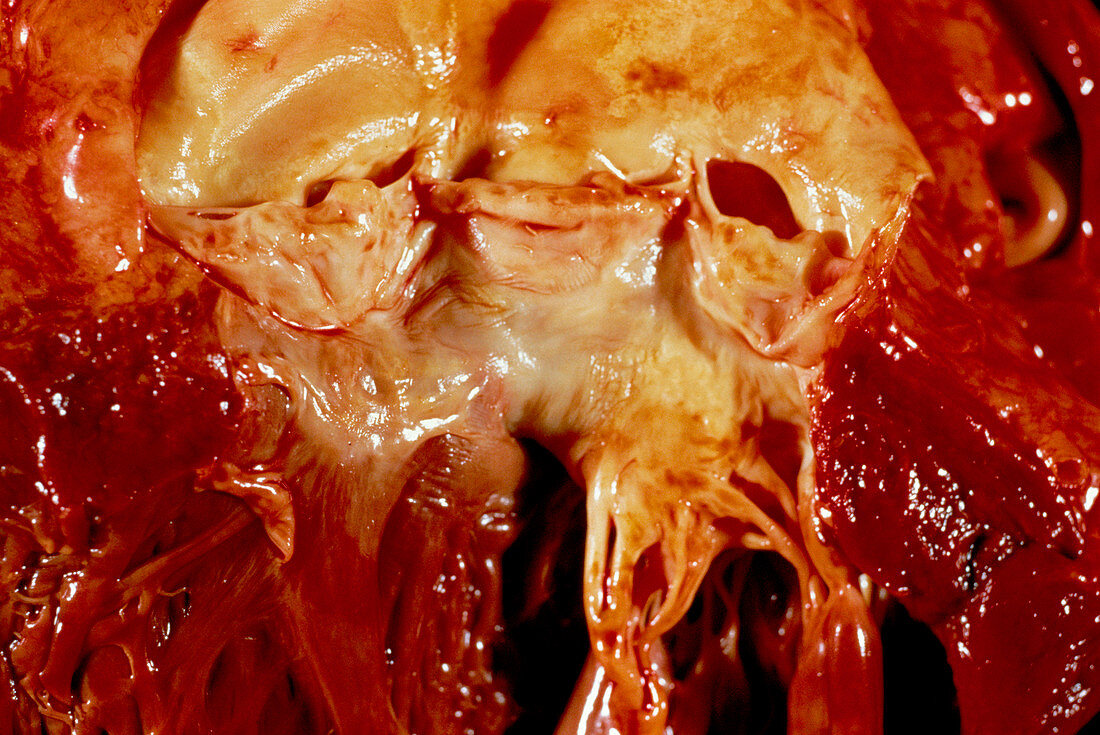 Aortic insufficiency