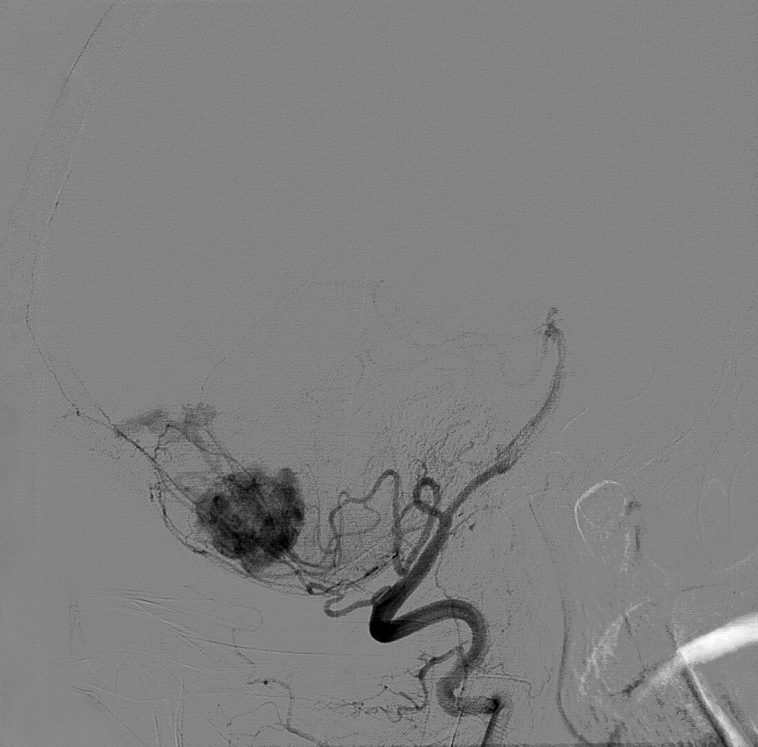 Haemangioblastoma brain tumour,MRA scan