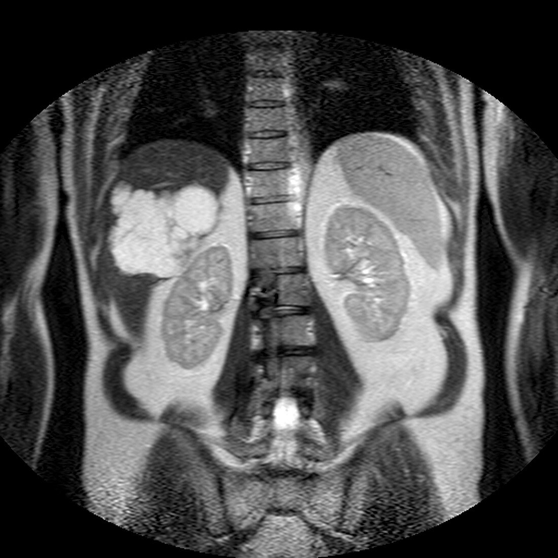 Liver blood vessel tumour,MRI scan