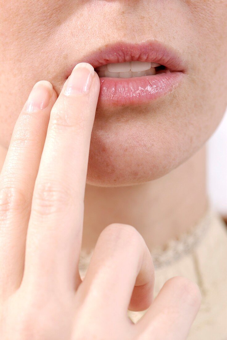 Developing a cold sore