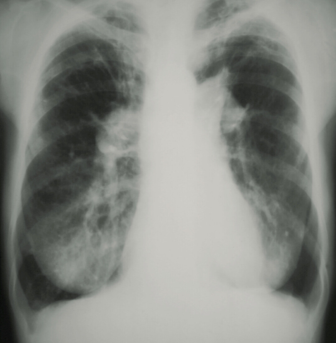 Pulmonary hypertension,X-ray