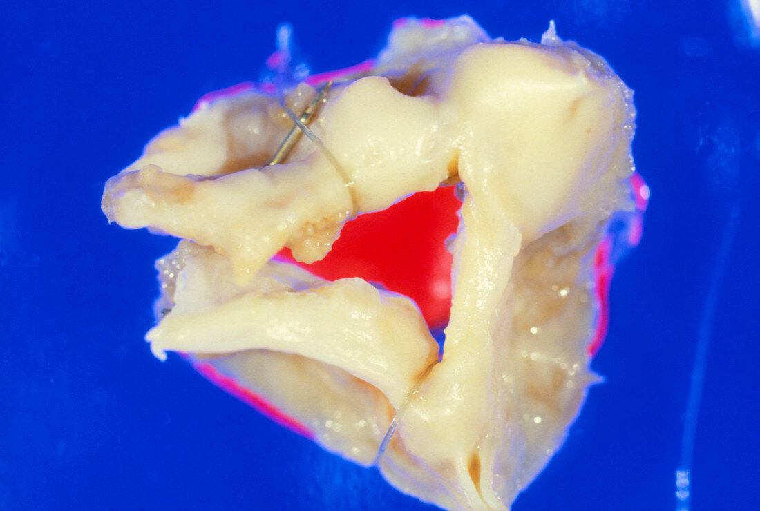 Gross specimen of stenosed aortic valve