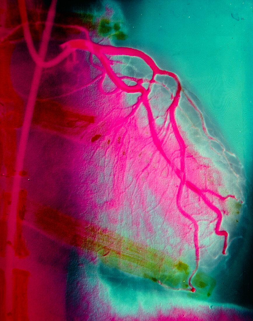 Coronary artery narrowing of the heart