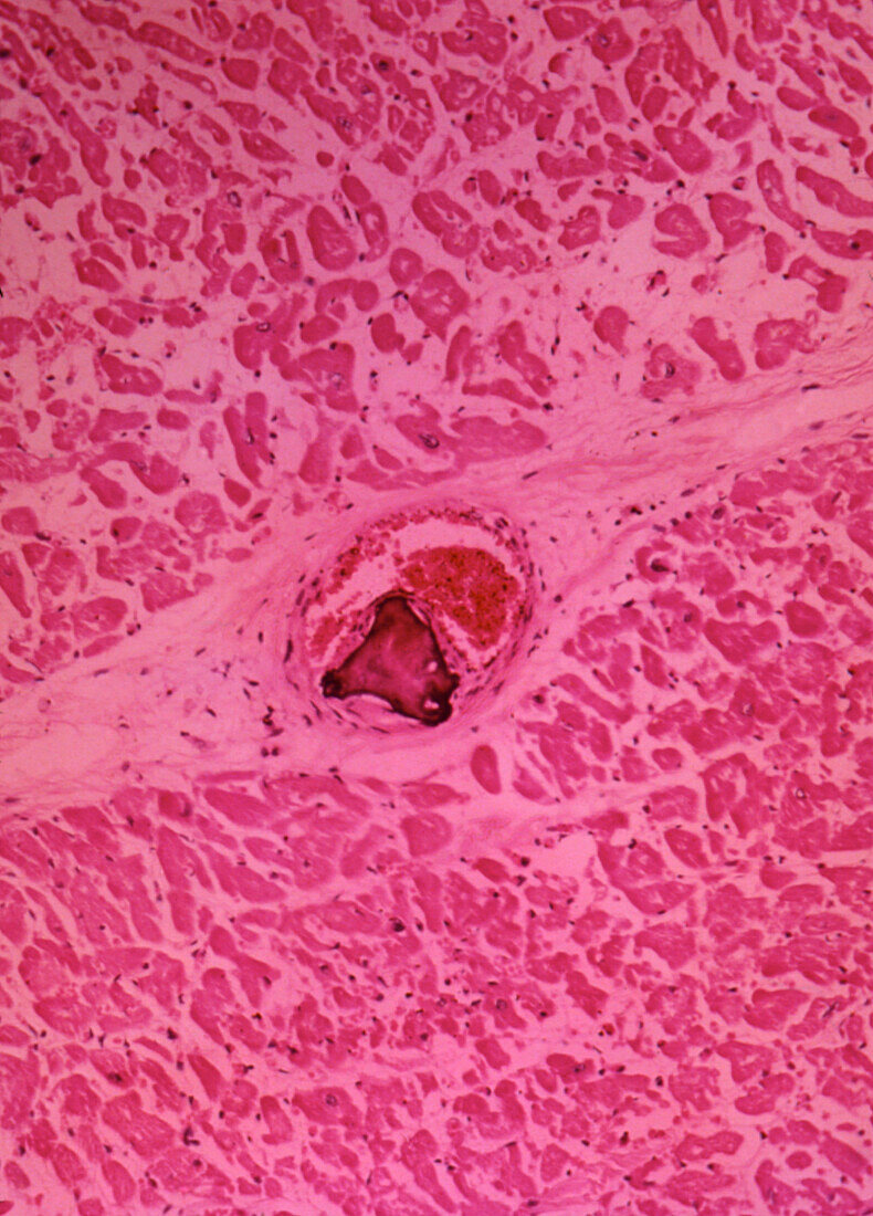 LM myocardium showing calcified embolus in artery