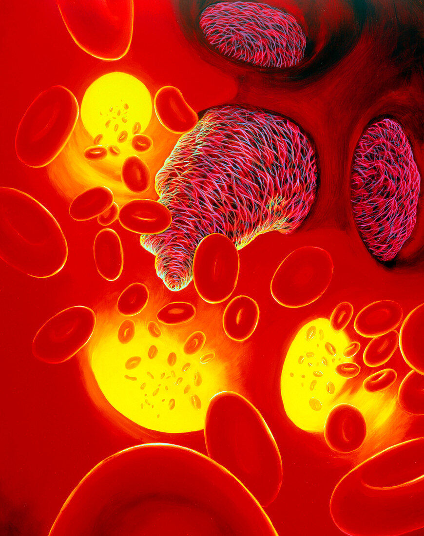 Illustration of a coronary thrombosis: blood clot