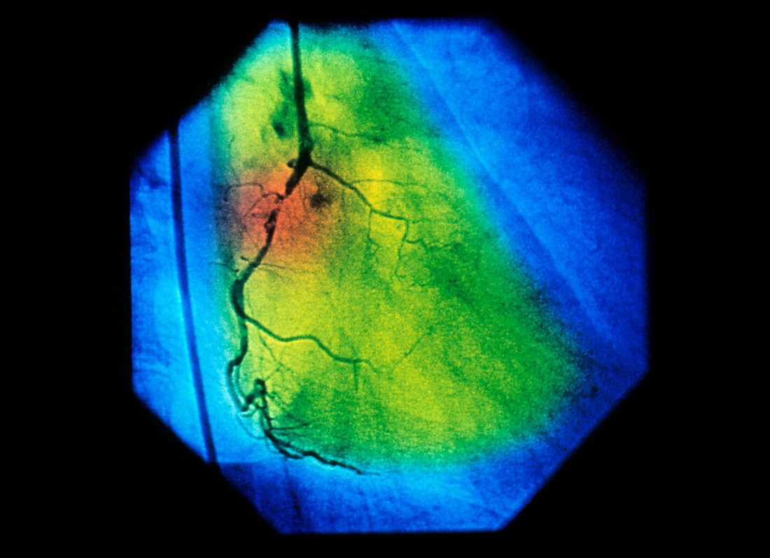 False-colour coronary angiogram: stenosis